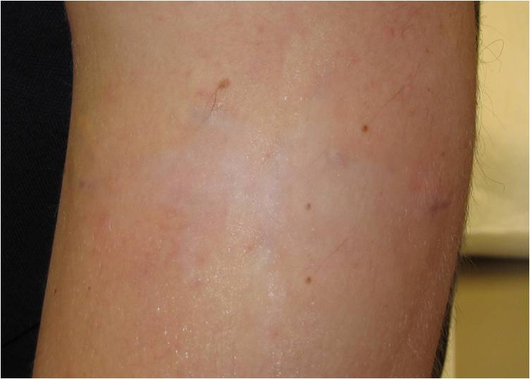 Tattoo After Laser Treatment